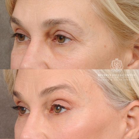 AuraLyft™, Tempral Brow Reset, Cupid Lift®, TCA Peel (Eyes)