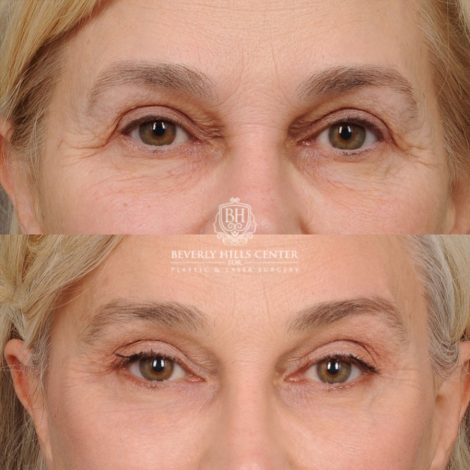 AuraLyft™, Tempral Brow Reset, Cupid Lift®, TCA Peel (Eyes)