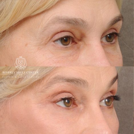 AuraLyft™, Tempral Brow Reset, Cupid Lift®, TCA Peel (Eyes)