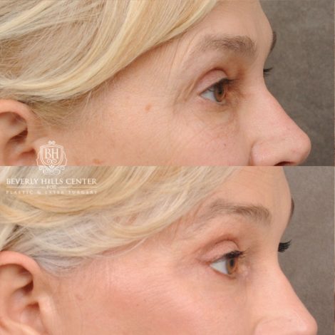 AuraLyft™, Tempral Brow Reset, Cupid Lift®, TCA Peel (Eyes)