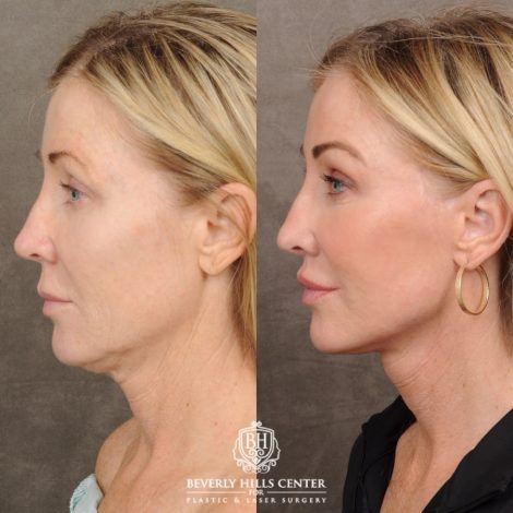 Beverly Hills Center Female Patient Before and After AuraLyft™, Fat Transfer to face, and CO2 around eyes