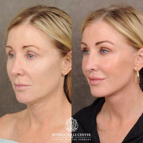 Beverly Hills Center Female Patient Before and After AuraLyft™, Fat Transfer to face, and CO2 around eyes