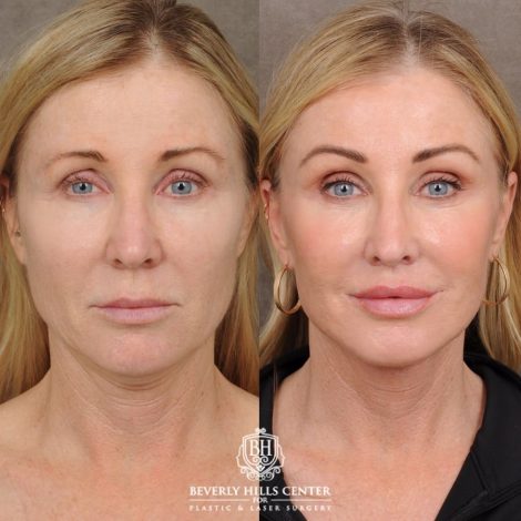 Beverly Hills Center Female Patient Before and After AuraLyft™, Fat Transfer to face, and CO2 around eyes