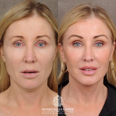 Beverly Hills Center Female Patient Before and After AuraLyft™, Fat Transfer to face, and CO2 around eyes