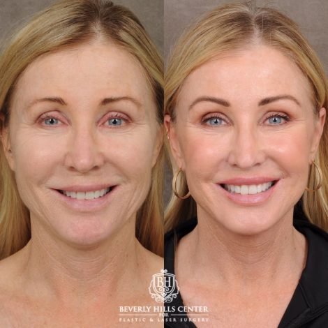 Beverly Hills Center Female Patient Before and After AuraLyft™, Fat Transfer to face, and CO2 around eyes