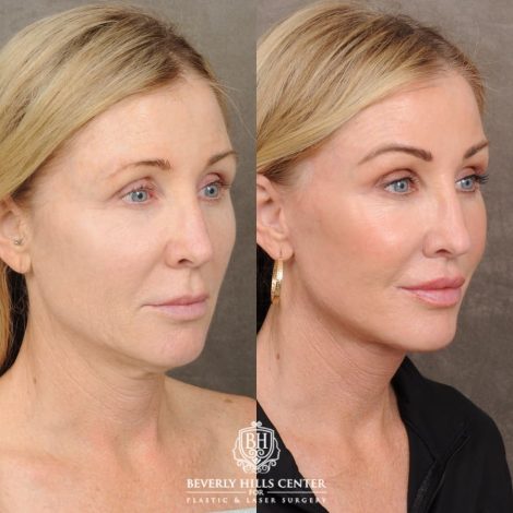 Beverly Hills Center Female Patient Before and After AuraLyft™, Fat Transfer to face, and CO2 around eyes