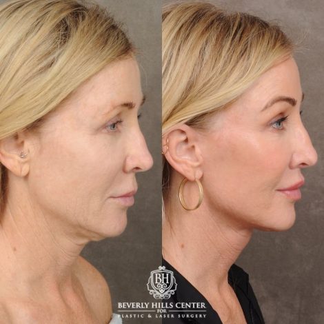 Beverly Hills Center Female Patient Before and After AuraLyft™, Fat Transfer to face, and CO2 around eyes