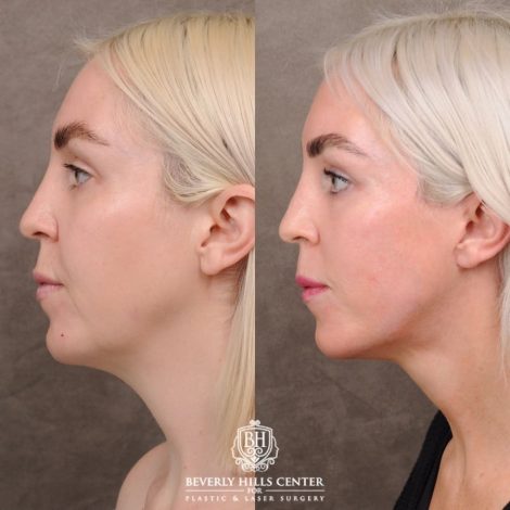 Beverly Hills Center Female Patient Before and After Auralyft