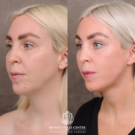 Beverly Hills Center Female Patient Before and After Auralyft