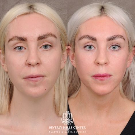 Beverly Hills Center Female Patient Before and After Auralyft