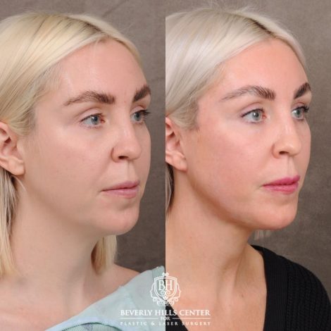Beverly Hills Center Female Patient Before and After Auralyft