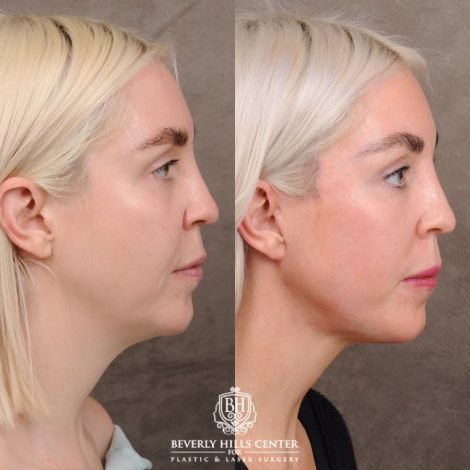 Beverly Hills Center Female Patient Before and After Auralyft