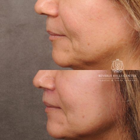 Beverly Hills Center Female Patient Before and After Cupid Lift® Lip Lift