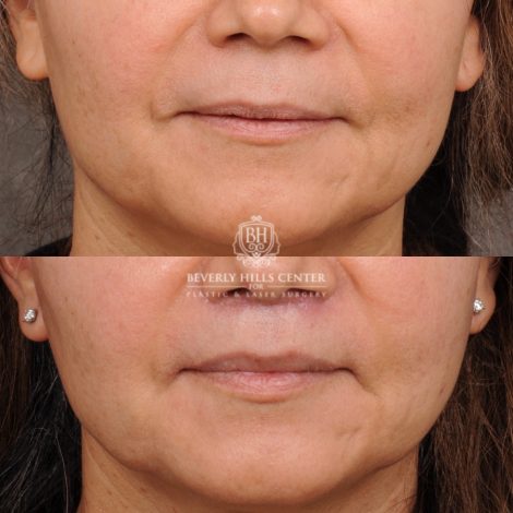 Beverly Hills Center Female Patient Before and After Cupid Lift® Lip Lift