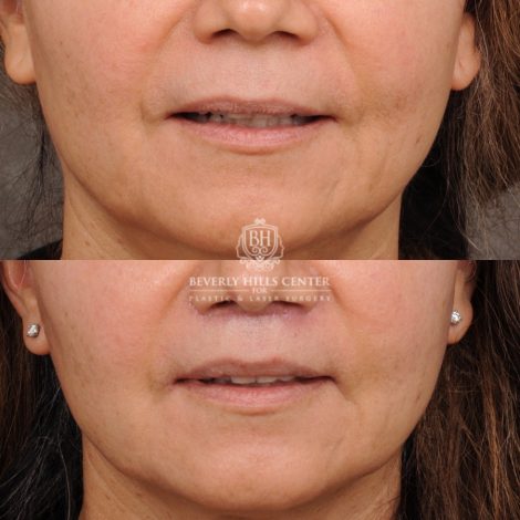 Beverly Hills Center Female Patient Before and After Cupid Lift® Lip Lift
