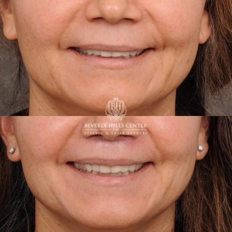 Beverly Hills Center Female Patient Before and After Cupid Lift® Lip Lift