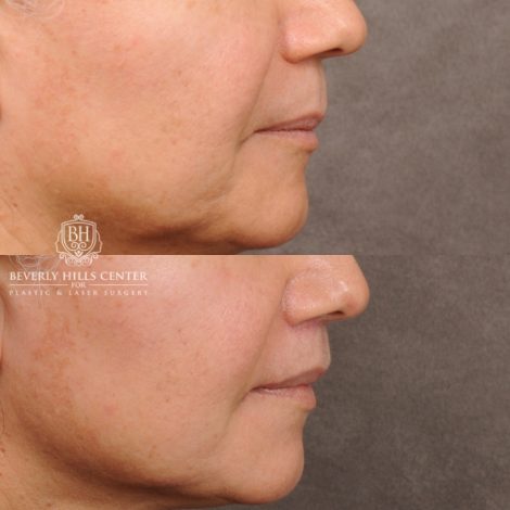 Beverly Hills Center Female Patient Before and After Cupid Lift® Lip Lift