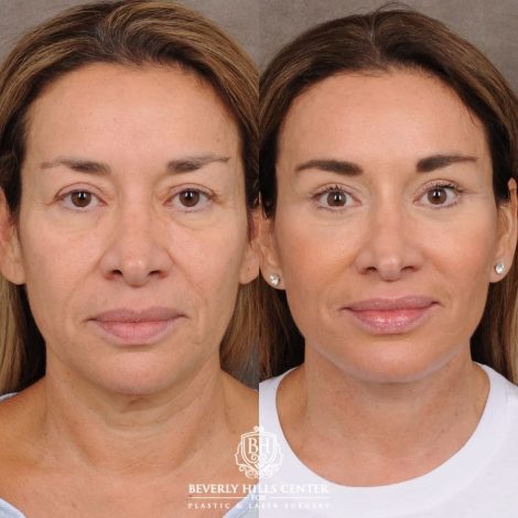 Beverly Hills Center Female Patient Before and After AuraLyft™, Upper & Lower Blepharoplasty, Ptosis Repair
