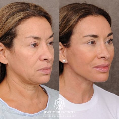 Beverly Hills Center Female Patient Before and After AuraLyft™, Upper & Lower Blepharoplasty, Ptosis Repair