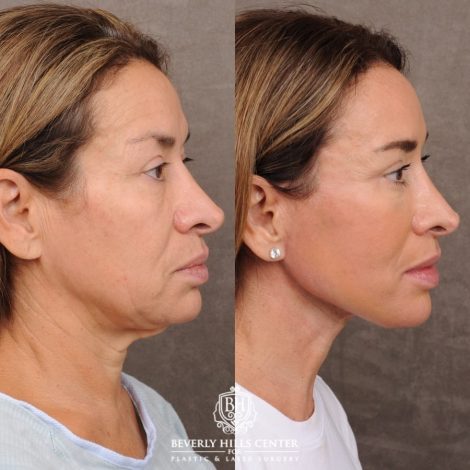 Beverly Hills Center Female Patient Before and After AuraLyft™, Upper & Lower Blepharoplasty, Ptosis Repair
