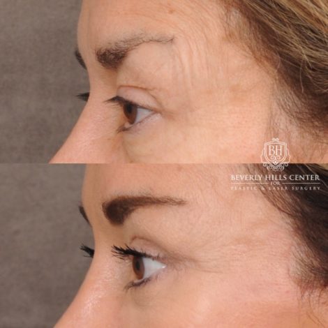 Beverly Hills Center Female Patient Before and After AuraLyft™, Upper & Lower Blepharoplasty, Ptosis Repair