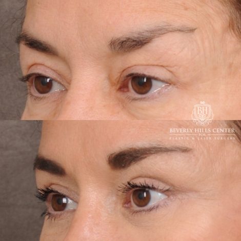 Beverly Hills Center Female Patient Before and After AuraLyft™, Upper & Lower Blepharoplasty, Ptosis Repair