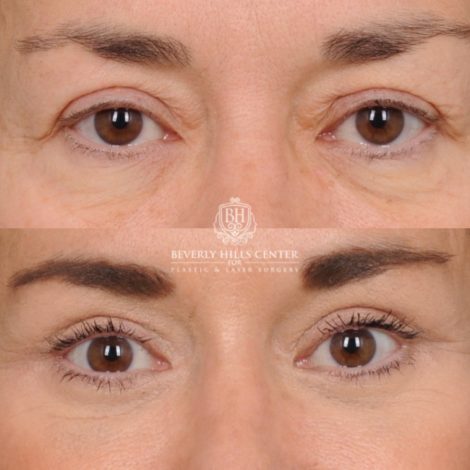 Beverly Hills Center Female Patient Before and After AuraLyft™, Upper & Lower Blepharoplasty, Ptosis Repair