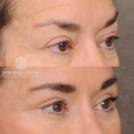 Beverly Hills Center Female Patient Before and After AuraLyft™, Upper & Lower Blepharoplasty, Ptosis Repair