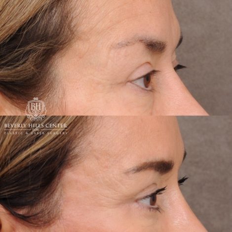Beverly Hills Center Female Patient Before and After AuraLyft™, Upper & Lower Blepharoplasty, Ptosis Repair