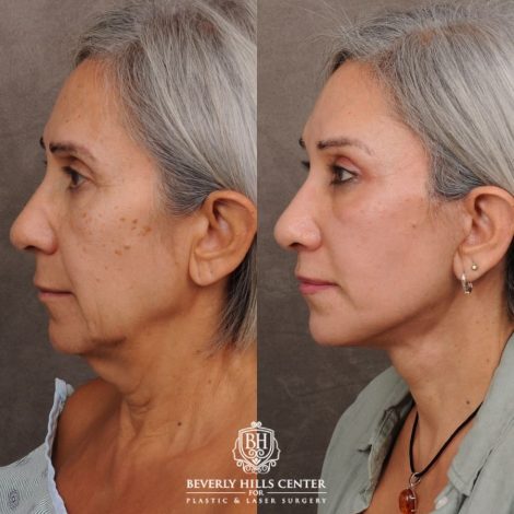 Beverly Hills Center Female Patient Before and After AuraLyft™, Temporal Brow Reset, Cupid Lift® Corner Lift