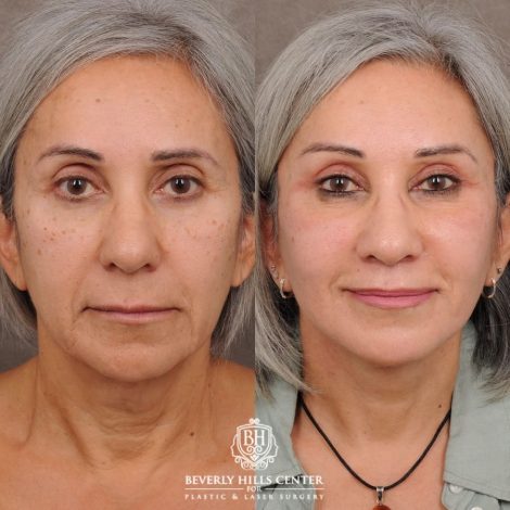 Beverly Hills Center Female Patient Before and After AuraLyft™, Temporal Brow Reset, Cupid Lift® Corner Lift
