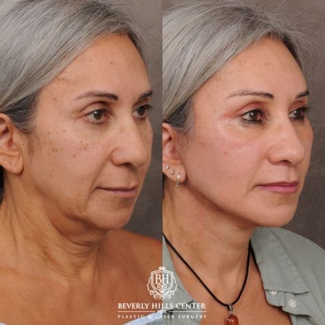 Beverly Hills Center Female Patient Before and After AuraLyft™, Temporal Brow Reset, Cupid Lift® Corner Lift