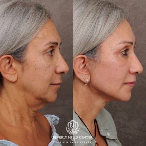 Beverly Hills Center Female Patient Before and After AuraLyft™, Temporal Brow Reset, Cupid Lift® Corner Lift