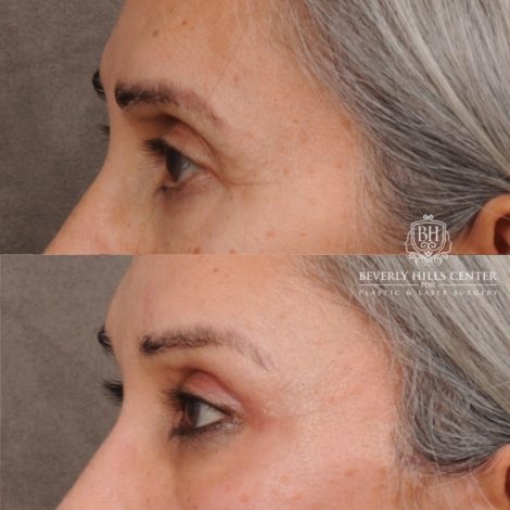 Beverly Hills Center Female Patient Before and After AuraLyft™, Temporal Brow Reset, Cupid Lift® Corner Lift