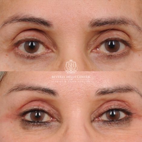 Beverly Hills Center Female Patient Before and After AuraLyft™, Temporal Brow Reset, Cupid Lift® Corner Lift