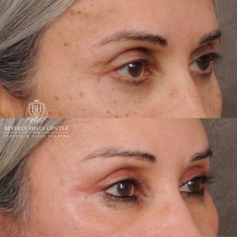 Beverly Hills Center Female Patient Before and After AuraLyft™, Temporal Brow Reset, Cupid Lift® Corner Lift