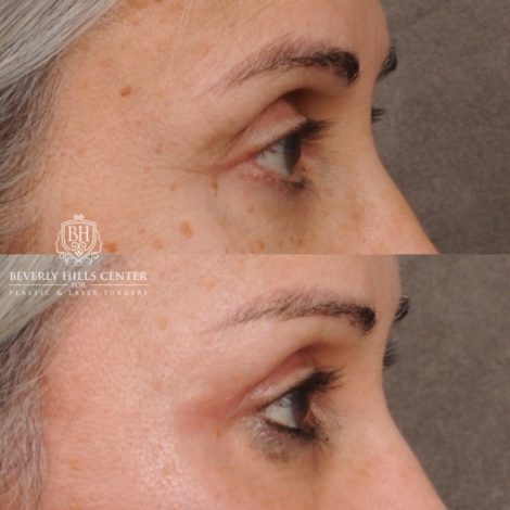 Beverly Hills Center Female Patient Before and After AuraLyft™, Temporal Brow Reset, Cupid Lift® Corner Lift