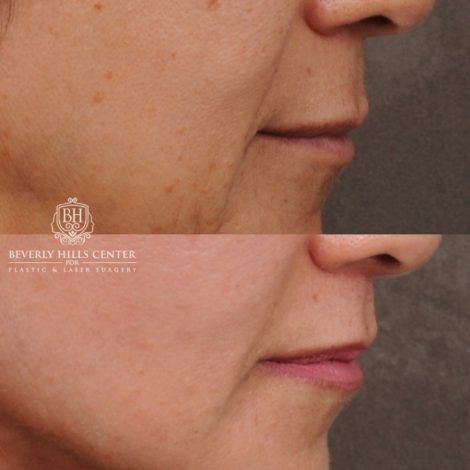 Beverly Hills Center Female Patient Before and After AuraLyft™, Temporal Brow Reset, Cupid Lift® Corner Lift