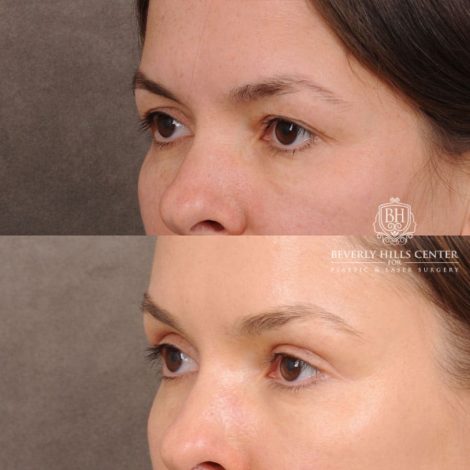 Beverly Hills Center Female Patient Before and After Temporal Brow Reset & Upper Blepharoplasty