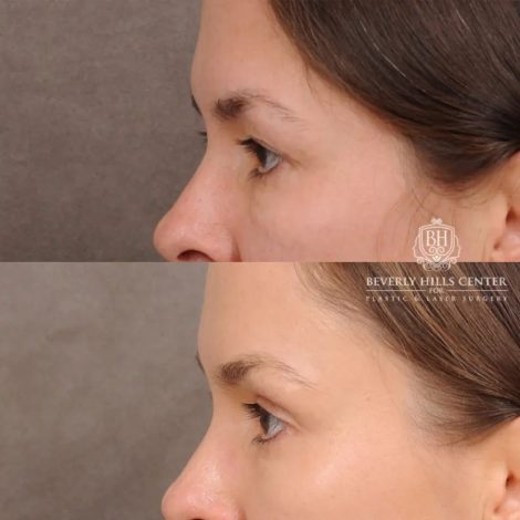 Beverly Hills Center Female Patient Before and After Temporal Brow Reset & Upper Blepharoplasty