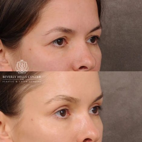 Beverly Hills Center Female Patient Before and After Temporal Brow Reset & Upper Blepharoplasty