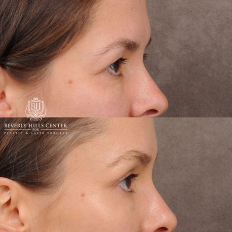 Beverly Hills Center Female Patient Before and After Temporal Brow Reset & Upper Blepharoplasty