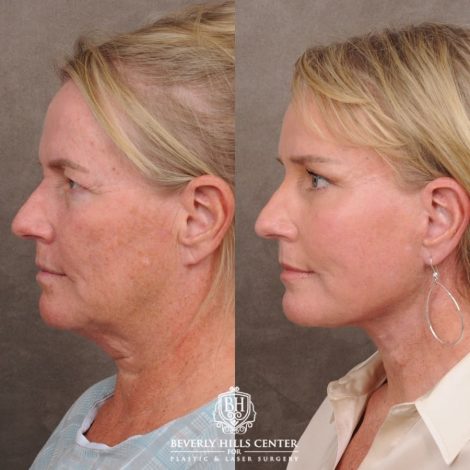 Beverly Hills Center Female Patient Before and After AuraLyft™, featuring the Cupid Lift™ Corner Lift, Temporal Brow Reset, and Fat Grafting