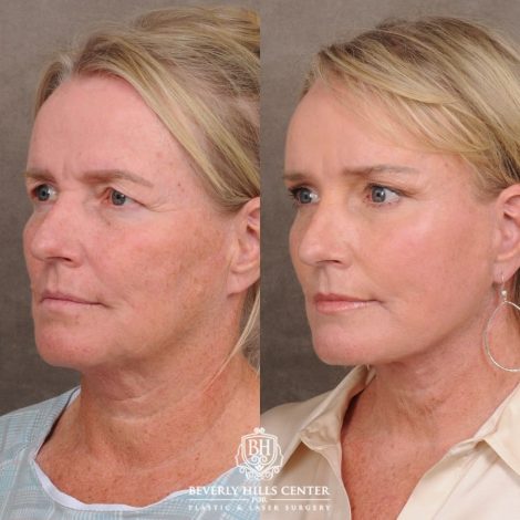 Beverly Hills Center Female Patient Before and After AuraLyft™, featuring the Cupid Lift™ Corner Lift, Temporal Brow Reset, and Fat Grafting