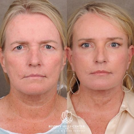 Beverly Hills Center Female Patient Before and After AuraLyft™, featuring the Cupid Lift™ Corner Lift, Temporal Brow Reset, and Fat Grafting
