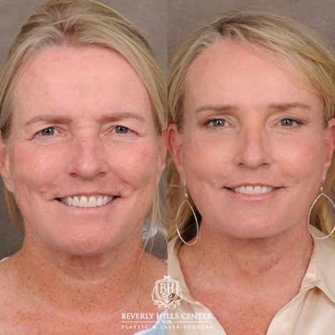 Beverly Hills Center Female Patient Before and After AuraLyft™, featuring the Cupid Lift™ Corner Lift, Temporal Brow Reset, and Fat Grafting