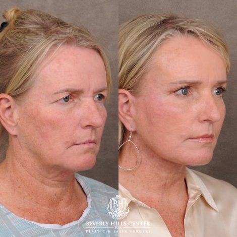 Beverly Hills Center Female Patient Before and After AuraLyft™, featuring the Cupid Lift™ Corner Lift, Temporal Brow Reset, and Fat Grafting
