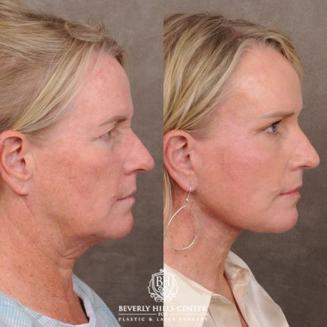 Beverly Hills Center Female Patient Before and After AuraLyft™, featuring the Cupid Lift™ Corner Lift, Temporal Brow Reset, and Fat Grafting