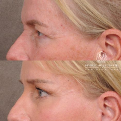 Beverly Hills Center Female Patient Before and After AuraLyft™, featuring the Cupid Lift™ Corner Lift, Temporal Brow Reset, and Fat Grafting