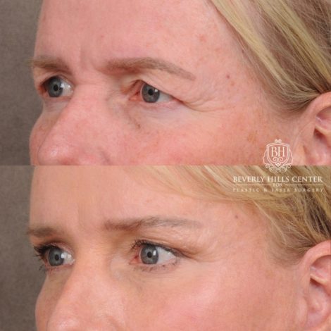 Beverly Hills Center Female Patient Before and After AuraLyft™, featuring the Cupid Lift™ Corner Lift, Temporal Brow Reset, and Fat Grafting